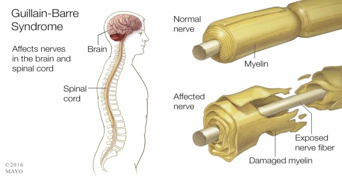 Case study guillain barre syndrome